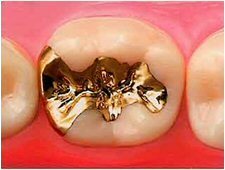 金合金　小臼歯